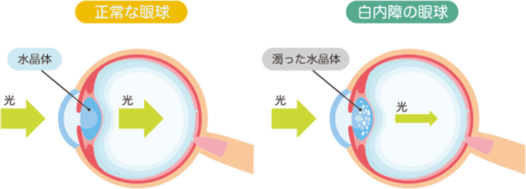 白内障とは